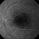 Central Serous Retinopathy (CSR) Central Serous Retinopathy (CSR)